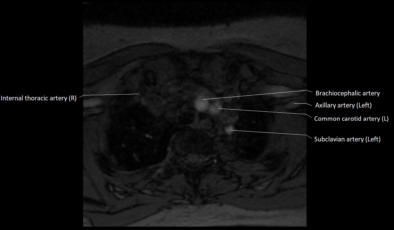 Carotid artery anatomy axial 3T image 76.jpg